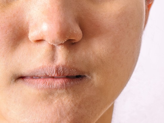 Zbliżenie na twarz osoby posiadającej bardzo suchą skórę