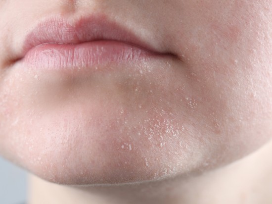 Zbliżenie na twarz osoby posiadajacej cerę suchą